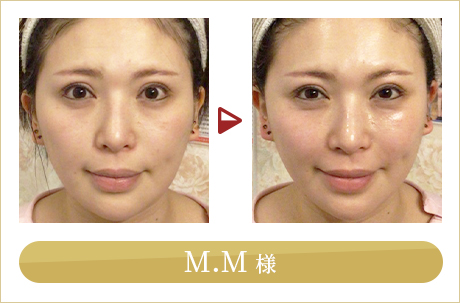 before after