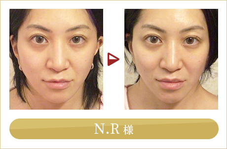 before after