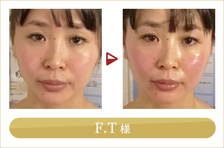 before after