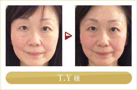 before after