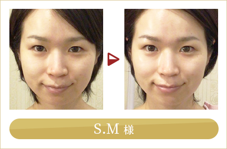 before after