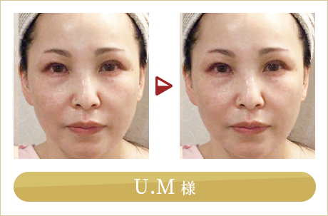 before after