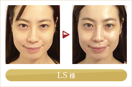before after
