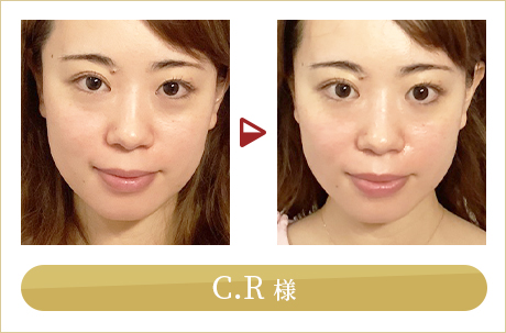 before after