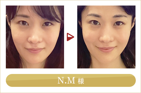 before after