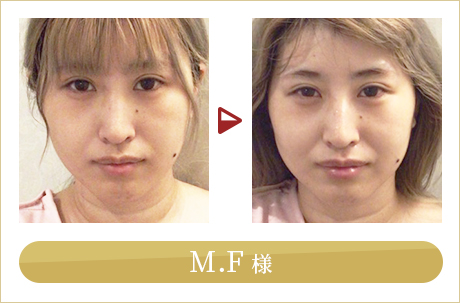 before after